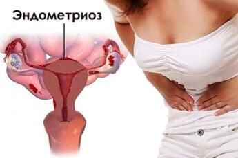 Лечение эндометриоза матки
